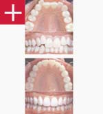 Allineamento dentale: Prima e dopo.
